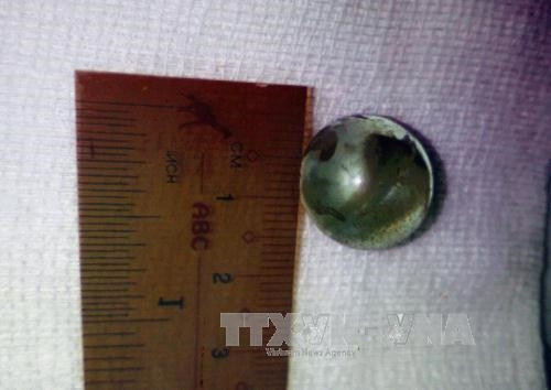 Viên bi được lấy ra trong mắt cho bệnh nhi Y Khương Mlo. Ảnh: Phương Vy-TTXVN.