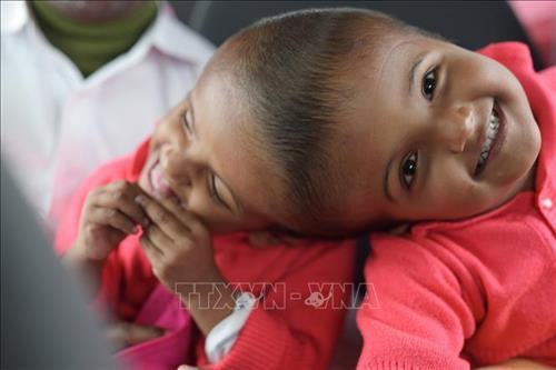 Hai bé song sinh người Bangladesh bị dính liền đầu, Rabeya và Rukaya, chuẩn bị được phẫu thuật tách rời tại thủ đô Dhaka, ngày 2/8/2019. Ảnh: AFP/TTXVN Hai bé song sinh người Bangladesh bị dính liền đầu, Rabeya và Rukaya, chuẩn bị được phẫu thuật tách rời tại thủ đô Dhaka, ngày 2/8/2019. Ảnh: AFP/TTXVN