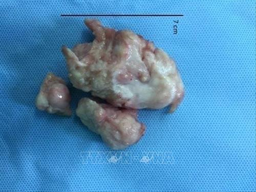 Khối u cơ tim lớn có kích thước7x4x3.5cm của bệnh nhi 4 tháng tuổi. Ảnh: TTXVN phát