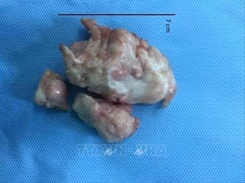 Khối u cơ tim lớn có kích thước7x4x3.5cm của bệnh nhi 4 tháng tuổi. Ảnh: TTXVN phát