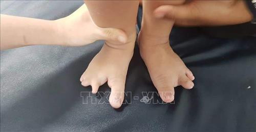 Bàn chân bệnh nhi trước khi phẫu thuật. Ảnh: TTXVN phát
