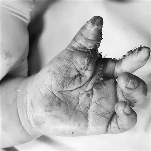 Bàn tay của bệnh nhi sau khi phẫu thuật. Ảnh: TTXVN phát