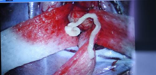 Các bác sĩ đã lấy ra trong não của anh A một con sán nhái dài 7 cm Các bác sĩ đã lấy ra trong não của anh A một con sán nhái dài 7 cm