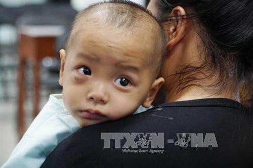 Bé trai sau khi phẫu thuật biến chứng ổ mắt do viêm xoang. Ảnh: Phương Vy - TTXVN