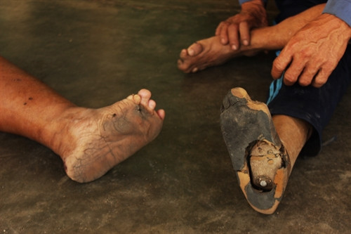 Đôi bàn chân của hai anh chị A Nức và Mơ Li đều bị căn bệnh quái ác tàn phá nặng nề Đôi bàn chân của hai anh chị A Nức và Mơ Li đều bị căn bệnh quái ác tàn phá nặng nề