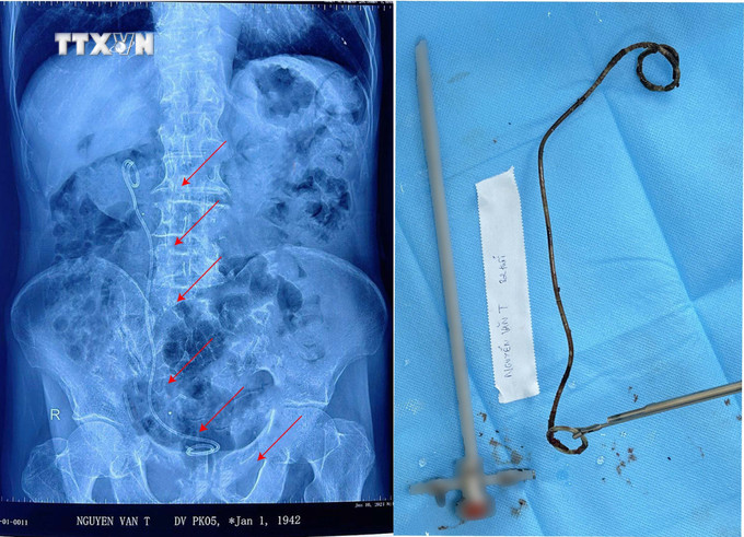 Ông thông sonde JJ dài hơn 20cm, đã đổi màu đen, bám đầy sỏi được lấy ra khỏi cơ thể bệnh nhân. Ảnh: TTXVN phát vna_potal_can_tho_hy_huu_ong_lao_82_tuoi_co_ong_sonde_jj_dai_hon_20_cm_“ngu_quen”_ca_nam_trong_bang_quang__7435293.jpg