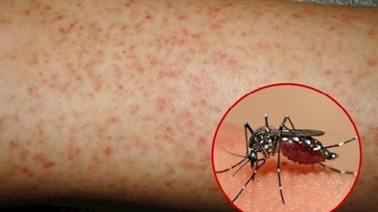 An Giang: Bệnh sốt xuất huyết gia tăng