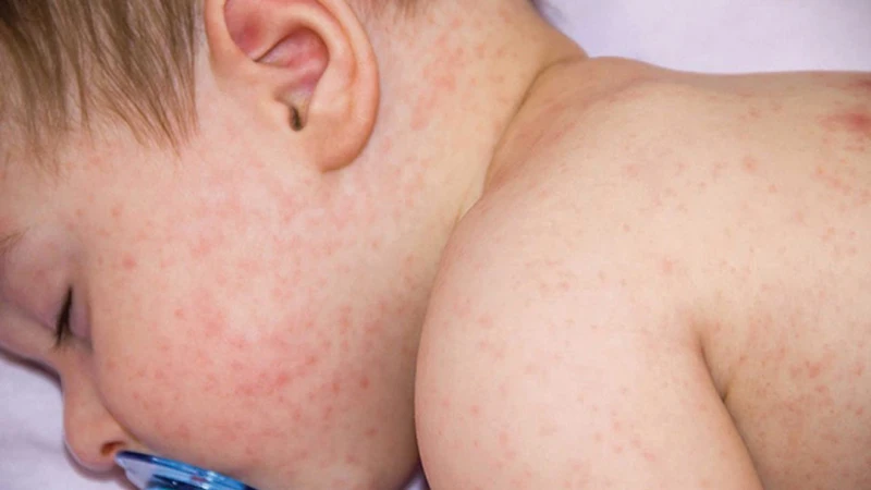 Phát hiện mới về việc ngăn ngừa nguy cơ dị ứng ở trẻ em
