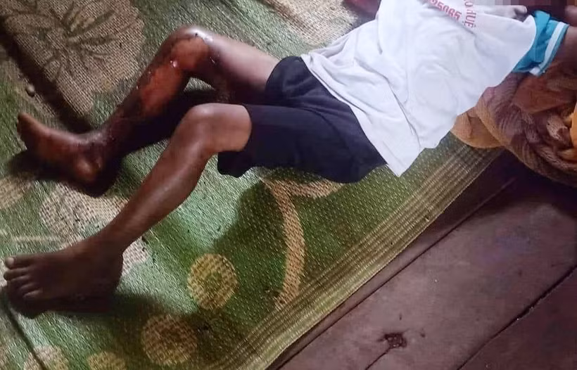 Đắk Lắk tạm giữ hình sự một đối tượng trong vụ việc cháu bé 8 tuổi bị bỏng xăng