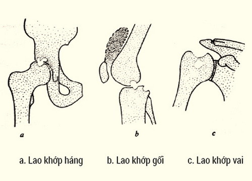 Bệnh lao xương khớp: Xin đừng chủ quan