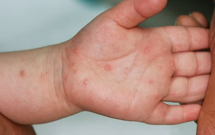 Ninh Thuận tăng cường giám sát, kịp thời phát hiện và xử lý sớm ổ bệnh tay chân miệng