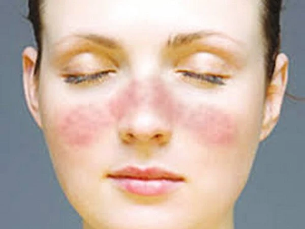 Phát hiện gene gây bệnh lupus ban đỏ