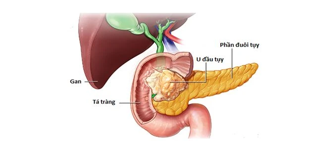 Phương pháp nội soi cắt khối tá tràng đầu tụy giúp người bệnh nhanh hồi phục