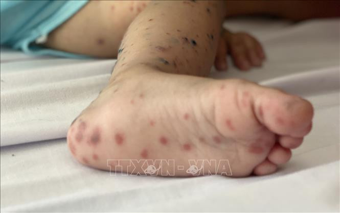 Đắk Lắk giám sát các khu vực có bệnh truyền nhiễm