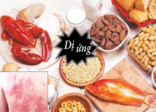 Người bị ​dị ứng thực phẩm có ít nguy cơ mắc COVID-19