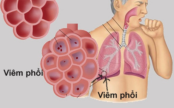 Phương pháp xét nghiệm mới giúp đánh giá mức độ nghiêm trọng của bệnh phổi hiếm gặp