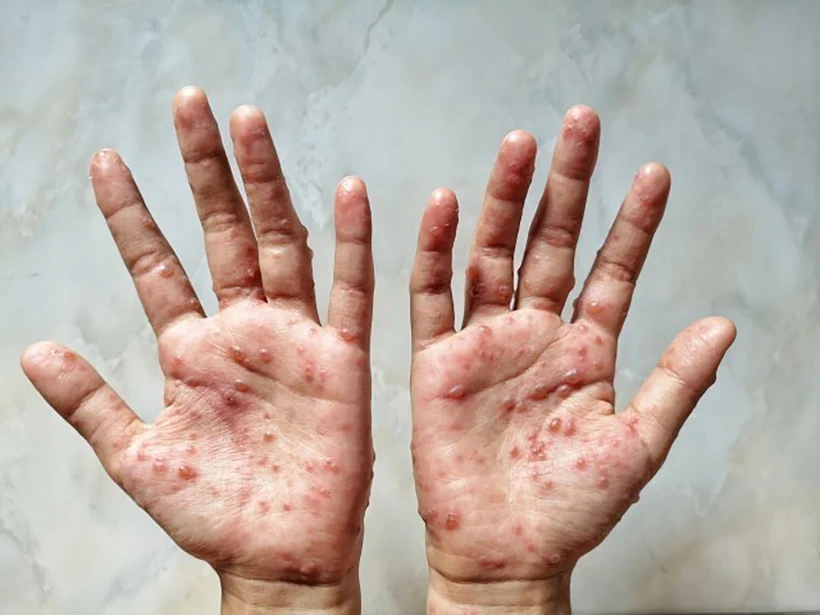 Thành phố Hồ Chí Minh triển khai các giải pháp giám sát dịch bệnh đậu mùa khỉ