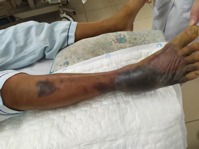 Cảnh báo nguy cơ hoại tử bàn chân do nhiễm vi khuẩn Vibrio vulnificus