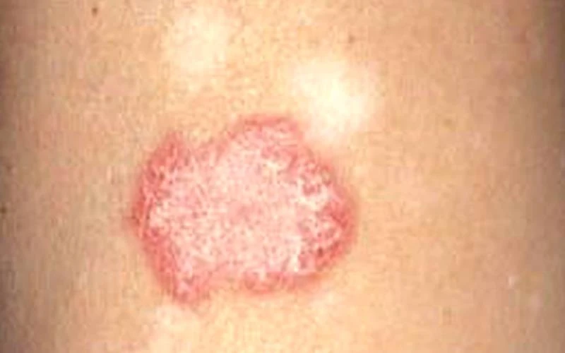 Tìm ra phương pháp mới điều trị lupus ban đỏ
