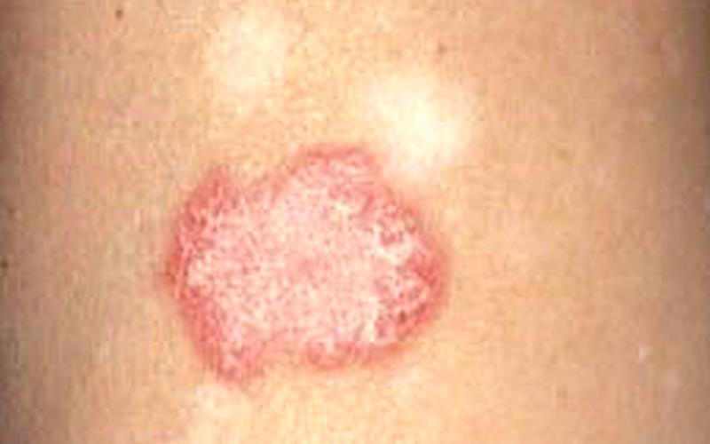 Tìm ra phương pháp mới điều trị lupus ban đỏ