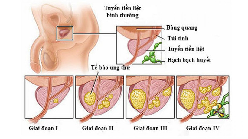 Kết hợp AI với hình ảnh mô 3D để xác định ung thư tuyến tiền liệt