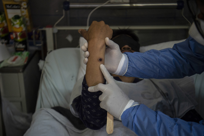 Bệnh nhân đậu mùa khỉ có thể truyền virus trước khi xuất hiện triệu chứng bệnh