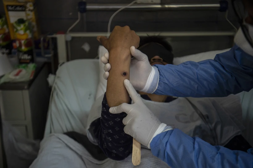 Bệnh nhân đậu mùa khỉ có thể truyền virus trước khi xuất hiện triệu chứng bệnh