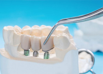 Bước tiến mới trong phát triển vật liệu nha khoa