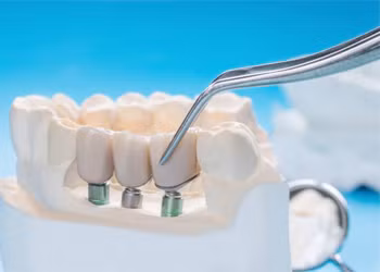 Bước tiến mới trong phát triển vật liệu nha khoa