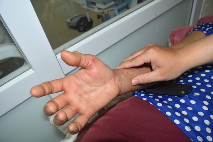 Bàn tay sưng nề của bệnh nhân sau khi bị rắn cắn. Ảnh: Nguyên Dung – TTXVN Bác sĩ khuyến cáo cách xử lý khi bị rắn độc cắn ảnh 2