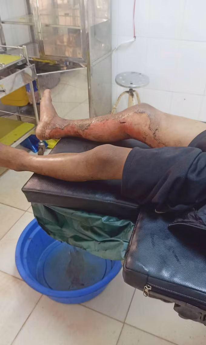 Đắk Lắk: Làm rõ vụ việc một cháu bé bị tẩm xăng đốt do không chịu đi trộm mủ cao su ảnh 1