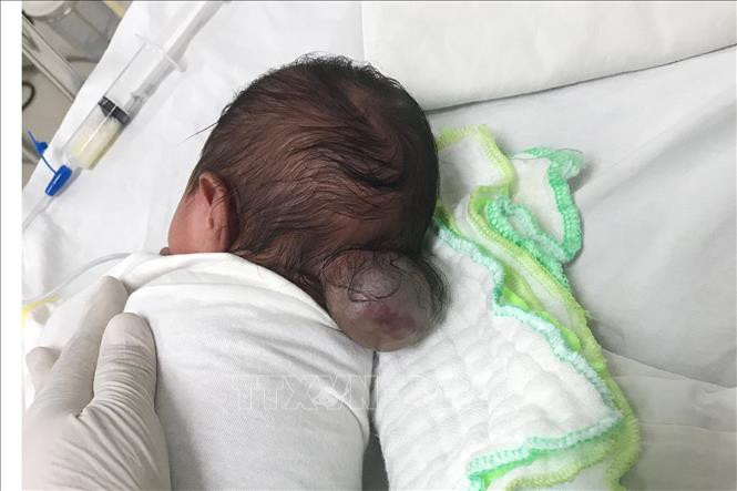 Bệnh nhi S.H. trước khi được phẫu thuật cắt bỏ khối thoát vị não chẩm kích thước lớn. Ảnh: TTXVN Phẫu thuật thành công bé sơ sinh có khối thoát vị não chẩm kích thước lớn ảnh 1