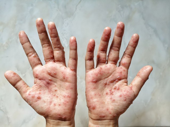 Các ban đỏ nổi trên tay một bệnh nhân mắc bệnh đậu mùa khỉ. Ảnh: Shutterstock/TTXVN Bộ Y tế ban hành hướng dẫn chẩn đoán, điều trị và phòng bệnh đậu mùa khỉ ở người ảnh 1
