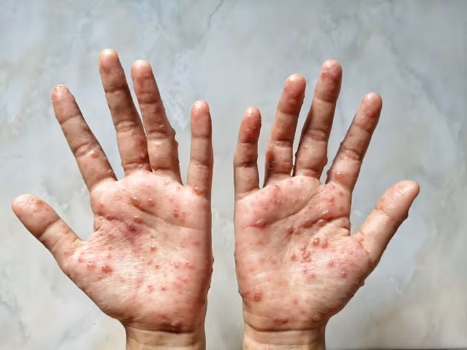 Bộ Y tế ban hành hướng dẫn chẩn đoán, điều trị và phòng bệnh đậu mùa khỉ ở người ảnh 1