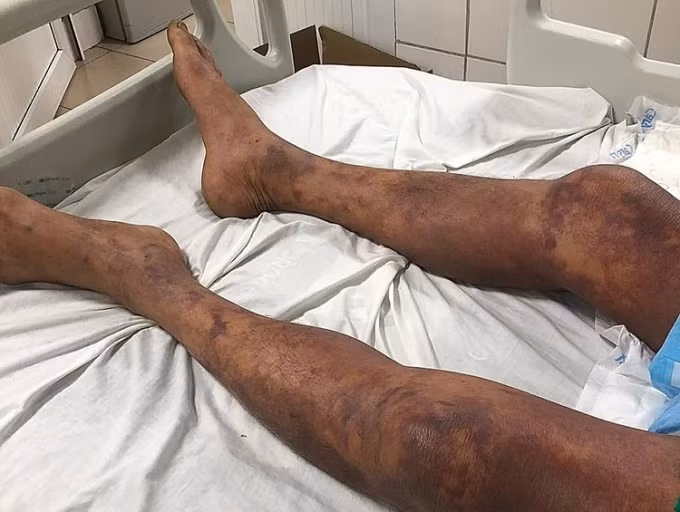 Giết mổ và ăn thịt lợn ốm, người đàn ông sốc nhiễm khuẩn, suy đa tạng