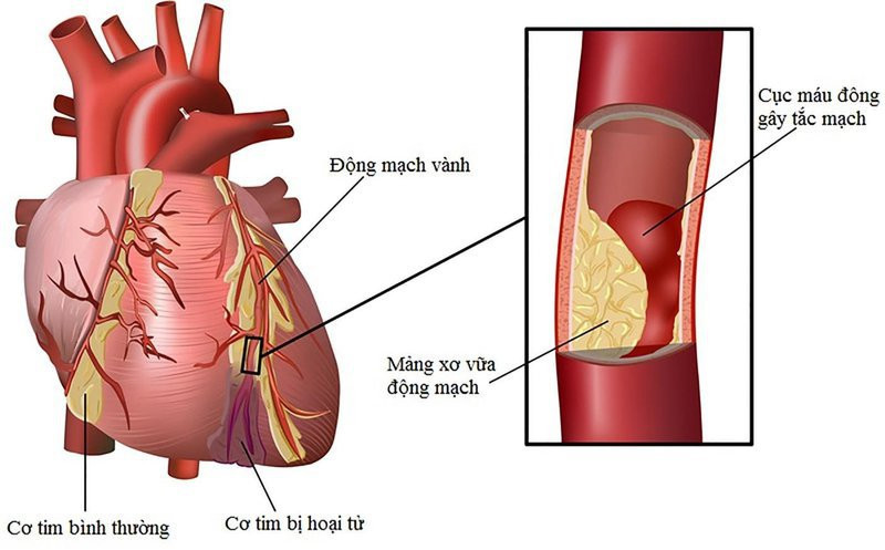 Báo động tình trạng thừa cholesterol gây các bệnh lý về tim mạch