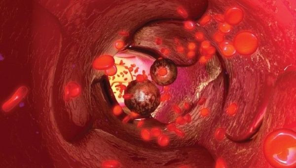 Phát hiện nguyên nhân khiến tế bào ung thư có thể di căn