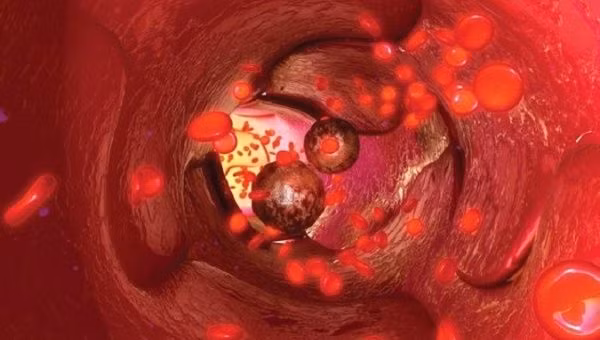 Phát hiện nguyên nhân khiến tế bào ung thư có thể di căn