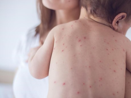 18 quận, huyện ở Hà Nội ghi nhận ca mắc thủy đậu
