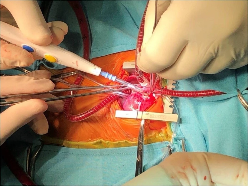 Nghiên cứu mới giúp điều trị rối loạn nhịp tim
