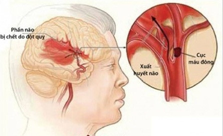 Cục máu đông gây đột quỵ não. Ảnh: benhvien108.vn
