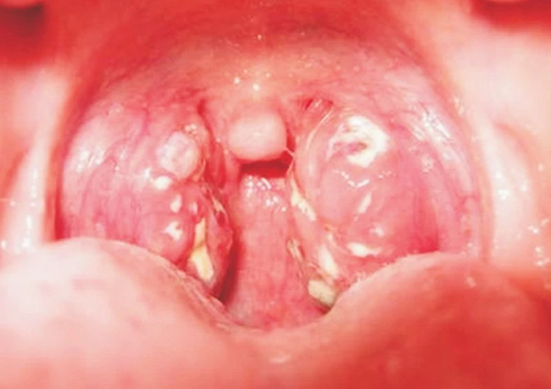 Bộ Y tế kiểm tra công tác phòng chống dịch bạch hầu tại tỉnh Đắk Nông