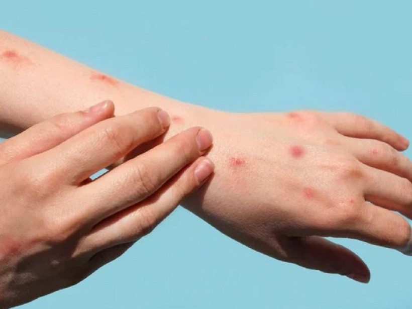 Tăng cường điều trị ca mắc đậu mùa khỉ, không để xảy ra lây nhiễm chéo