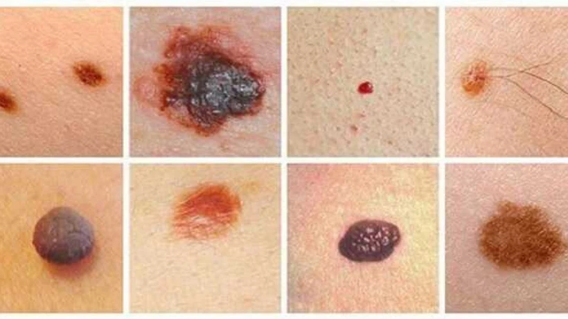 Bệnh nhân ung thư tế bào hắc tố có thể dễ mắc thêm ung thư tuyến tiền liệt