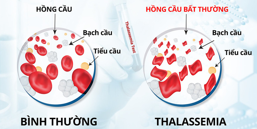  Phòng, chống bệnh tan máu bẩm sinh ở vùng đồng bào dân tộc thiểu số, miền núi