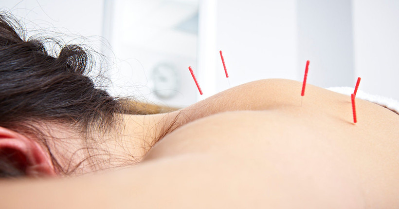 Châm cứu có thể giúp giảm đau trong phẫu thuật ung thư