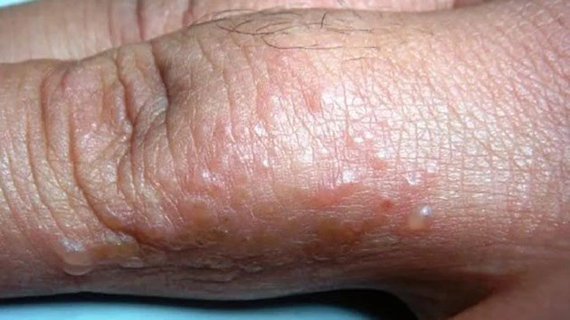 Quảng Ngãi: Xử lý bệnh ghẻ đang lây lan trong thôn có đông đồng bào dân tộc Cor
