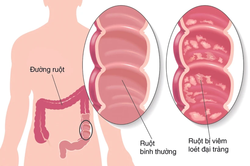 Liệu pháp mới điều trị hiệu quả bệnh viêm loét đại tràng