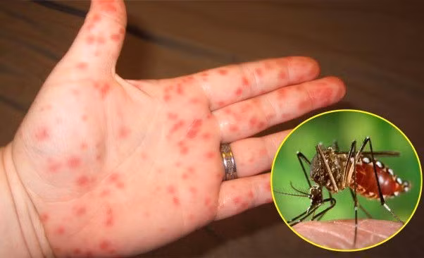 Lo ngại sốt xuất huyết, tay chân miệng, tiêu chảy... bùng phát, Bộ Y tế yêu cầu quyết liệt phòng, chống dịch