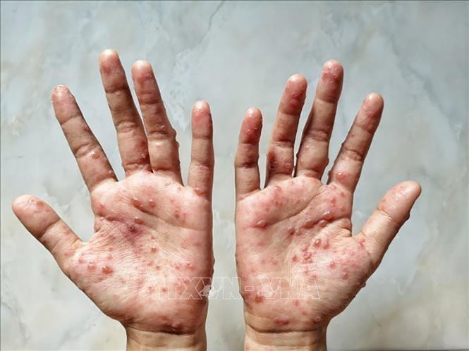 Người dân chủ động thực hiện các biện pháp phòng bệnh đậu mùa khỉ